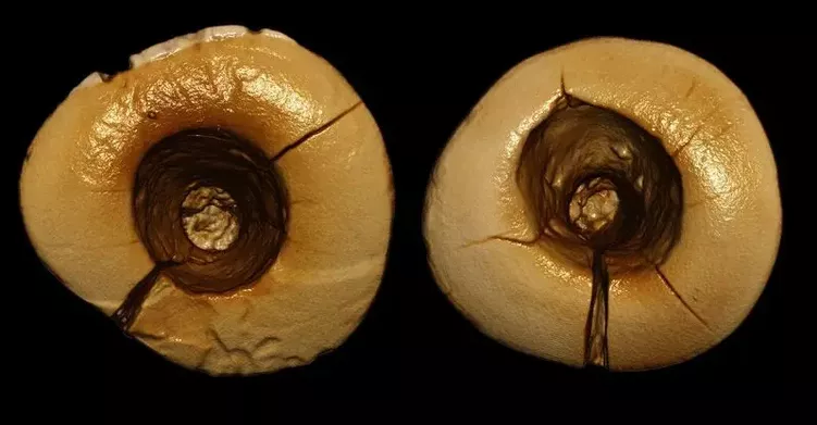 Ще 14 тисяч років тому люди вміли лікувати карієс